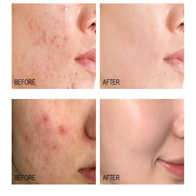 сыворотка от прыщей